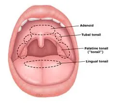 Tubal-tonsil-Image.jpg